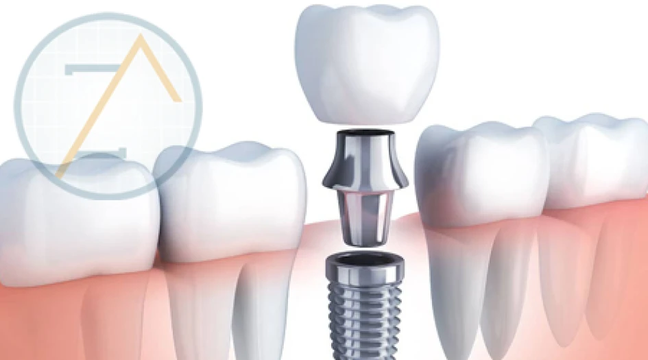 Ilustração anatômica de implante dentário de titânio integrado ao osso entre dentes naturais